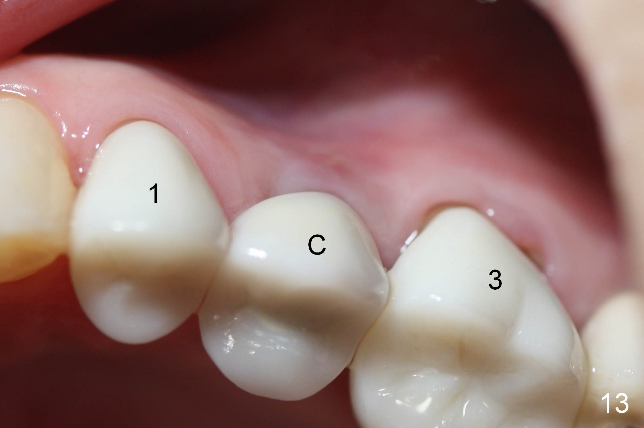 Implant Prevents Bone Gum Shrinking After Extraction Jaw CT Scan From 